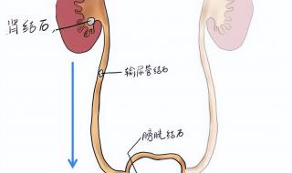 得了结石怎么办 有结石怎么排出